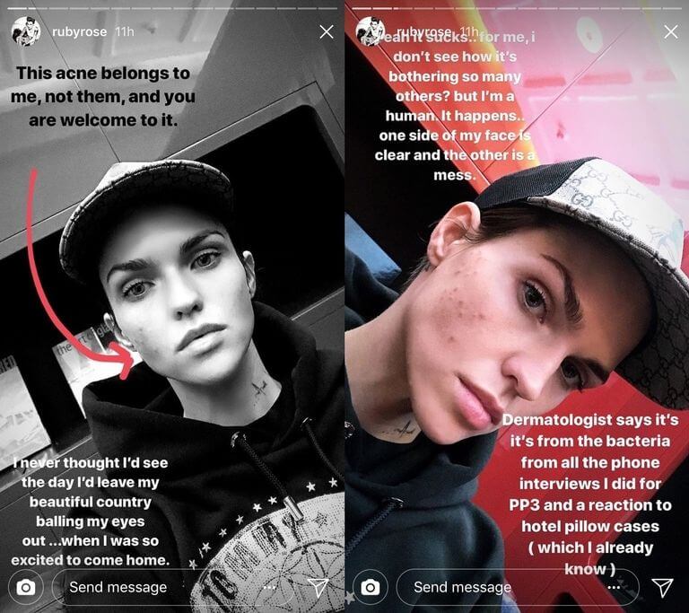 No Filter & Shame-Free Acne, Tren Kecantikan Terbaru di Instagram