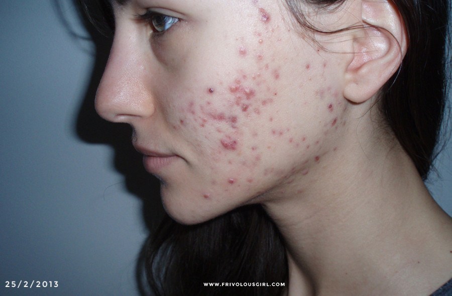 Cystic acne memang membutuhkan perawatan ekstra, Ladies. Apa sih bedanya dengan jerawat tipe lainnya dan bagaimana cara membasminya?