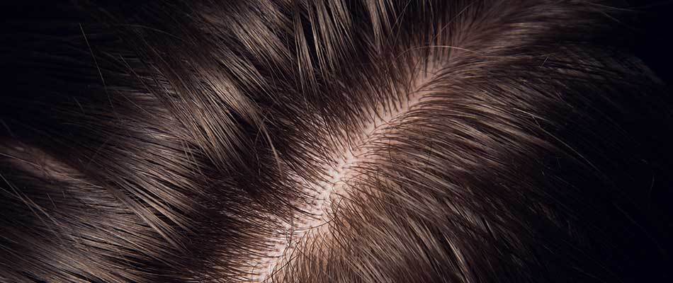 Mengapa Wajib Lakukan Scalp Detox dan Cara Terbaik Perawatan Kulit Kepala