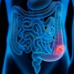 3d-illustration-of-colon-cancer-colon-tumor-royalty-free-image-1603910925_