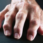 Gejala Rheumatoid Arthritis yang Perlu Kamu Tahu