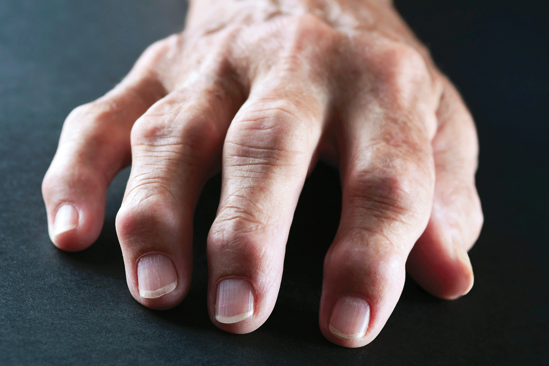 Rheumatoid arthritis adalah penyakit
