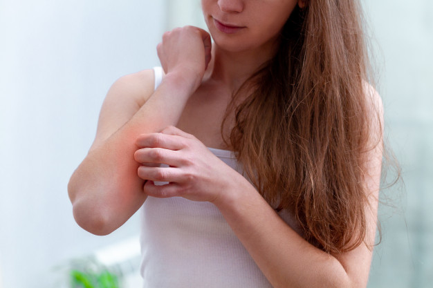Eczema: Penyebab, Gejala, Serta Cara Penanggulangannya