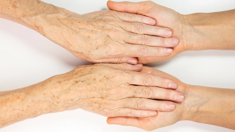 Pengertian dan Cara Menghilangkan Age Spot di Wajah dan Tangan