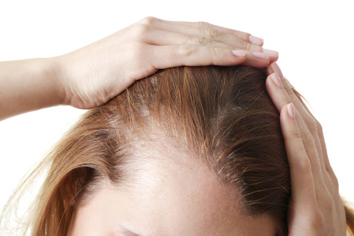 Para Peneliti Temukan Cara Lebih Cepat Tumbuhkan Rambut Karena Kebotakan