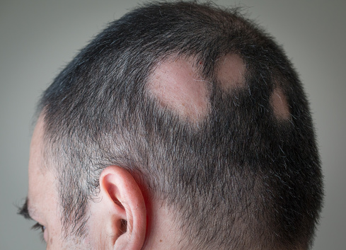 Alopecia: Kenali Penyakit Kerontokan Rambut dan Penyebabnya