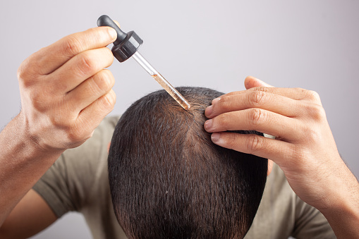 Alopecia: Kenali Penyakit Kerontokan Rambut dan Penyebabnya