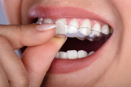 5 Cara Membuat Gigi Terlihat Lebih Menarik