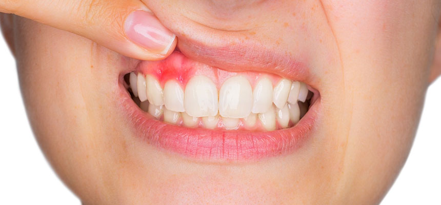 Seberapa Sering Sikat Gigi Harus Diganti dan Apa yang Terjadi Jika Kamu Tidak Menggantinya?