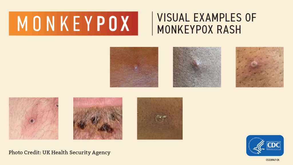 Monkeypox vs Cacar air: Perbedaan Perwujudan dan Gejalanya pada Pasien