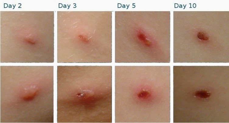 Monkeypox vs varicella: perbedaan manifestasi dan gejala pada pasien