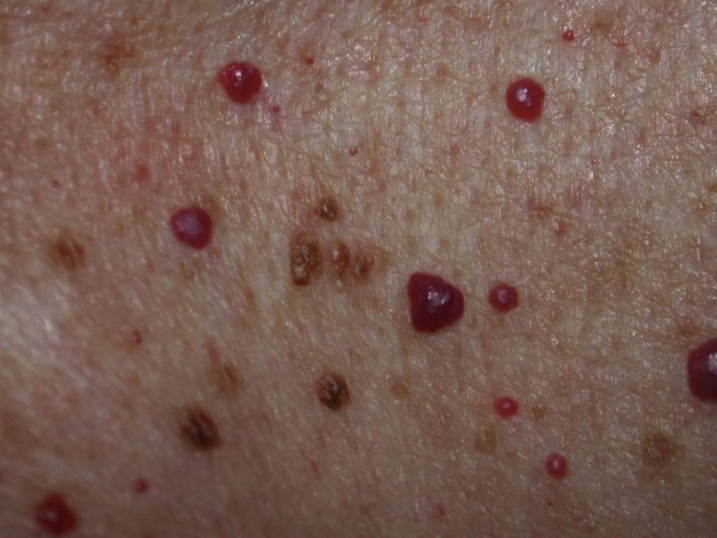 Tahi lalat merah muncul di kulit, apa yang harus dilakukan?