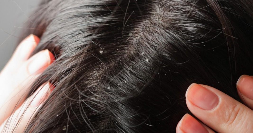 Mengenal Folikulitis yang Menyerang Folikel Rambut
