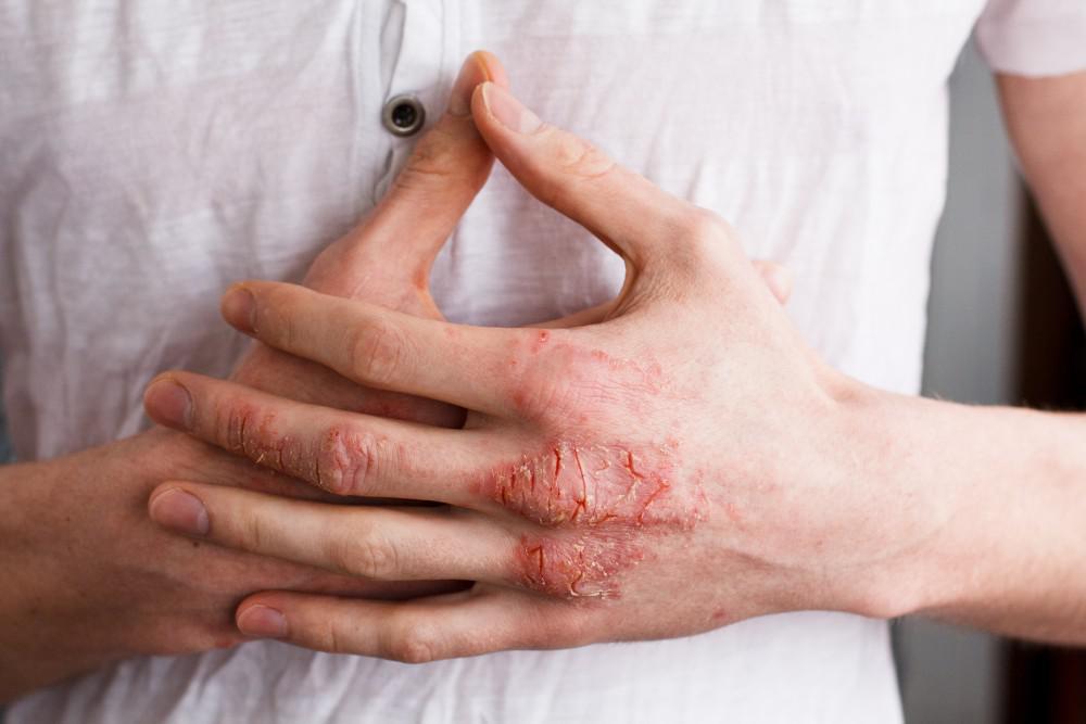 4 Bahan dalam Produk Kulit yang Harus Dihindari jika Memiliki Eksim/Eczema