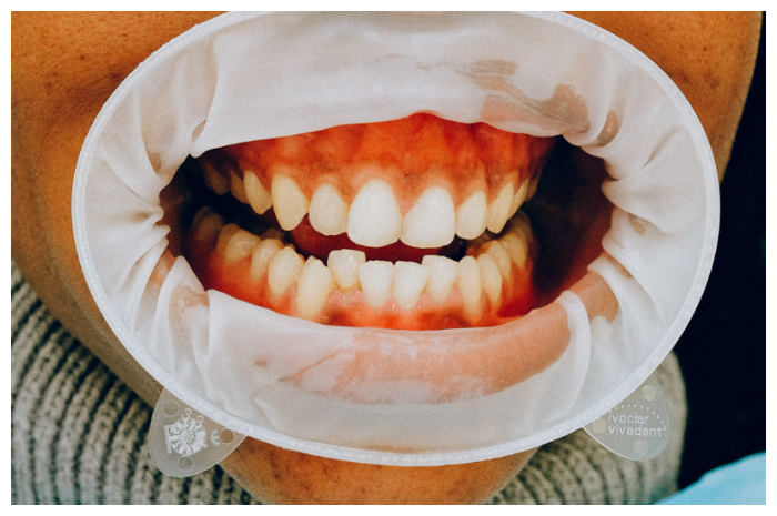 3 Cara Ampuh Menjaga Gigi agar Tetap Terlihat Putih untuk Pecinta Kopi
