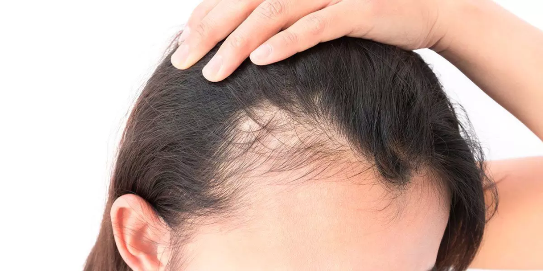 Para Ilmuwan Berhasil Ciptakan Teknologi Baru untuk Atasi Kebotakan Androgenic Alopecia