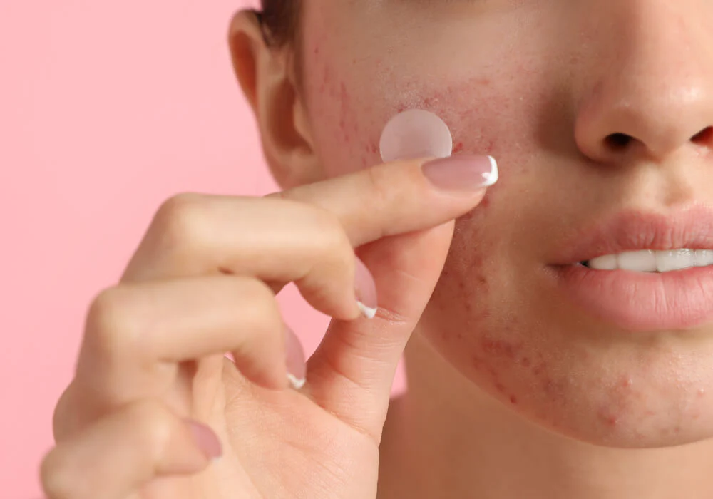 Pimple Patch jadi Produk Populer untuk Atasi Jerawat: Benar Berkhasiat atau Sekadar Produk Gimmick?