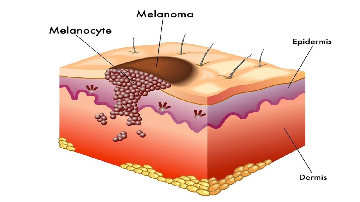 Mengenal Penyakit Melanoma yang Cukup Berbahaya